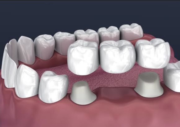 Screenshot Crown and bridges