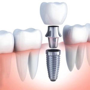 Dental Implant