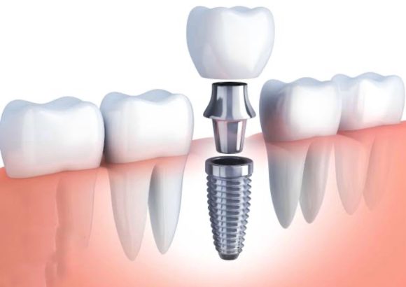 Screenshot Dental Implant