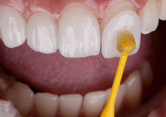 WhatsApp Image 2025-09-29 at 20.05.10 (1) Veneer