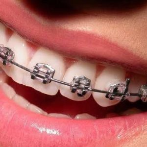 Teeth straightening/braces