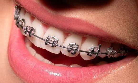WhatsApp Image 2025-10-08 at 17.48.36 Teeth straightening/braces